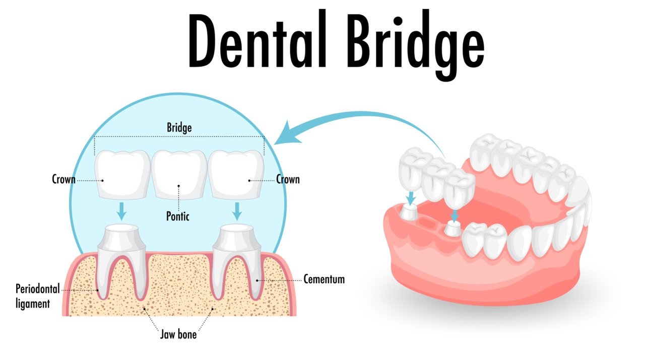 Bridges  image