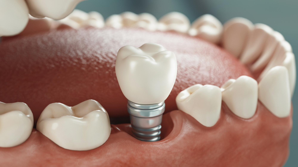 Implants  image